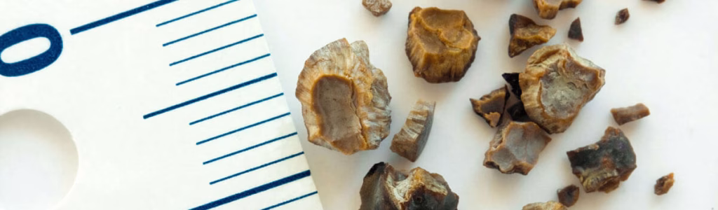 الطب النبوي لعلاج حصى الكلى