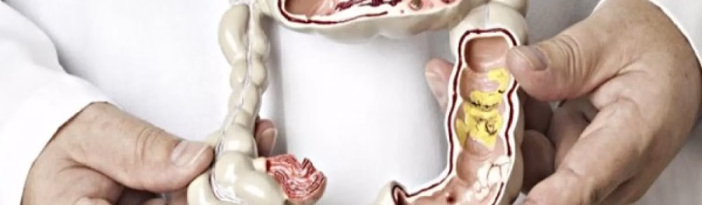 متلازمة تسرب الأمعاء