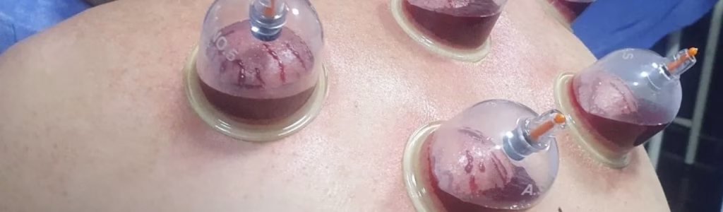 رجل يقوم بالحجامة الرطبة